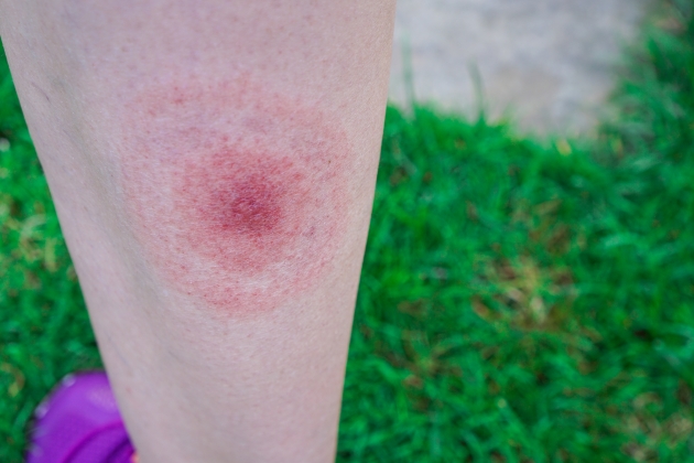 Typical lyme disease rash 630x420